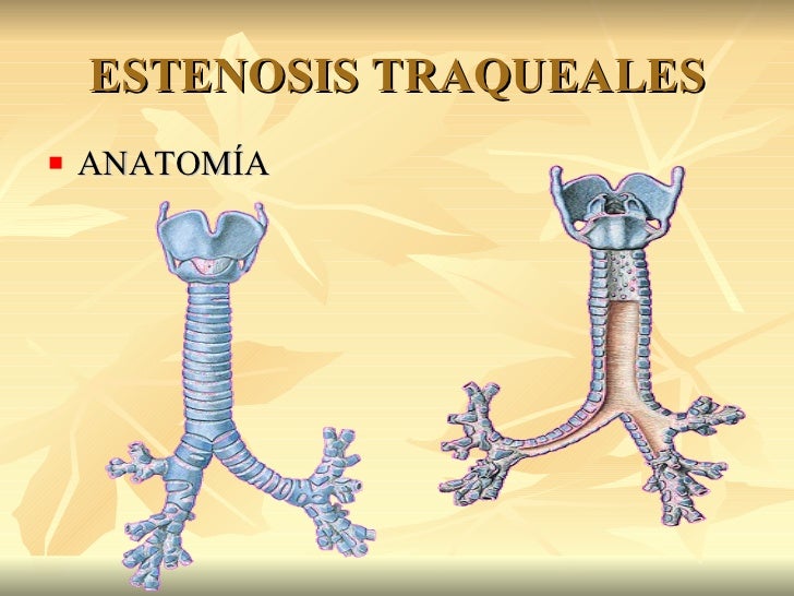 estenosis y atresia traqueal